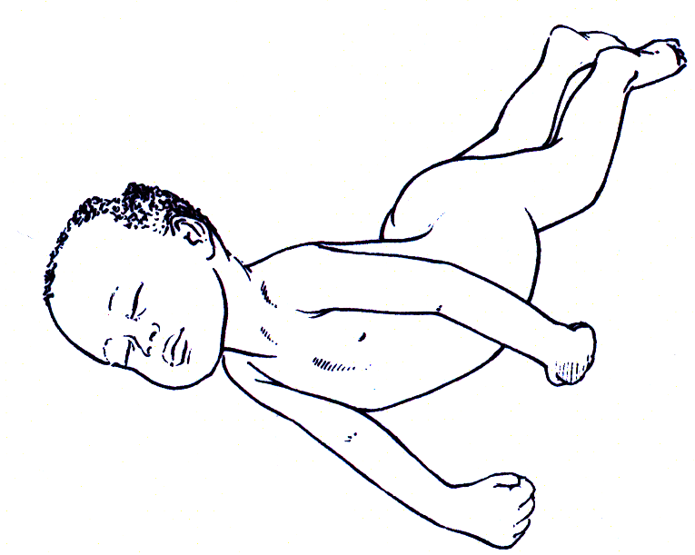 Менингит у ребенка 3. Опистотонус при менингите. Менингококковая инфекция поза легавой собаки. Менингеальные симптомы у новорожденных. Менингеальная поза легавой собаки.